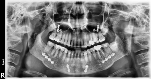 2D диагностика состояния зубов