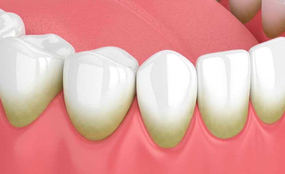 Методики удаления зубного камня