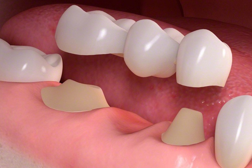 Протезирование зубов — виды в стоматологии