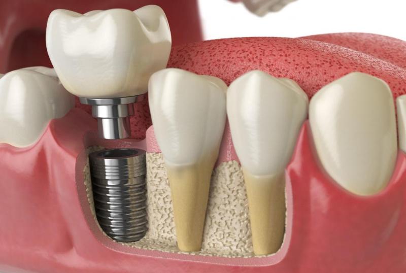 Имплантация зубов— костная пластика