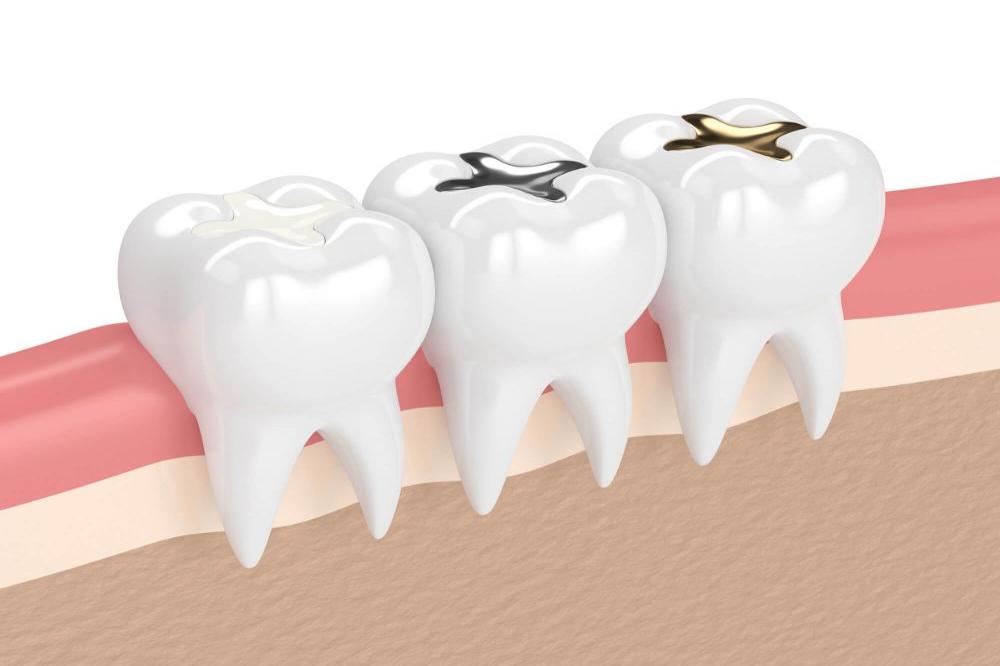Протезирование под вкладку — восстановление зубов