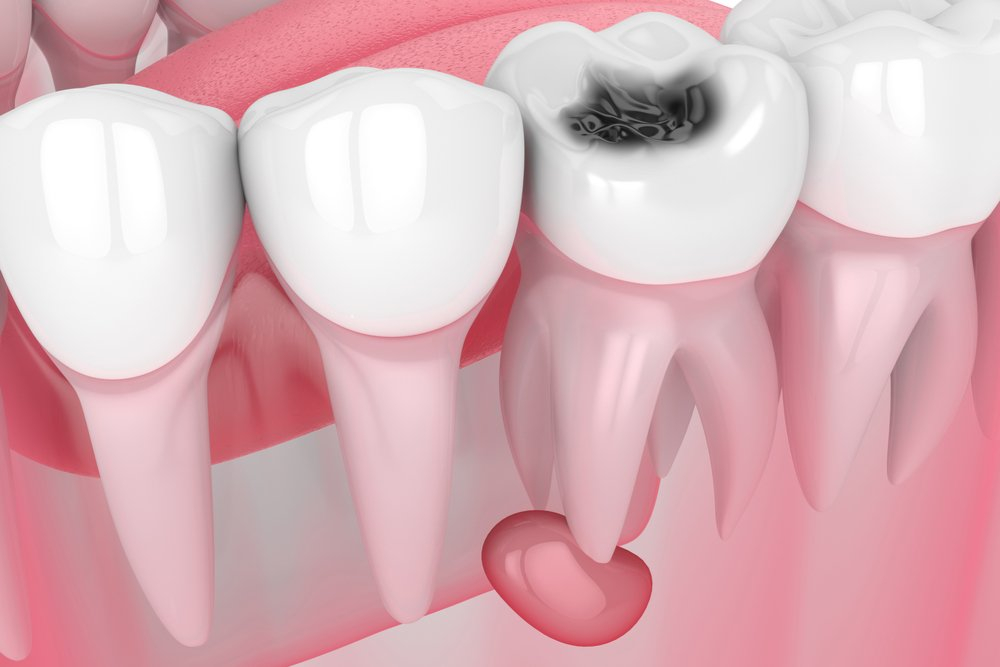 Диагностика и лечение — киста зуба