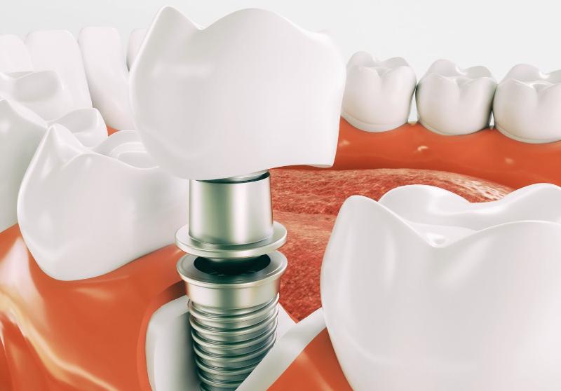Как устанавливают импланты зубов