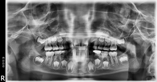 2D диагностика состояния зубов