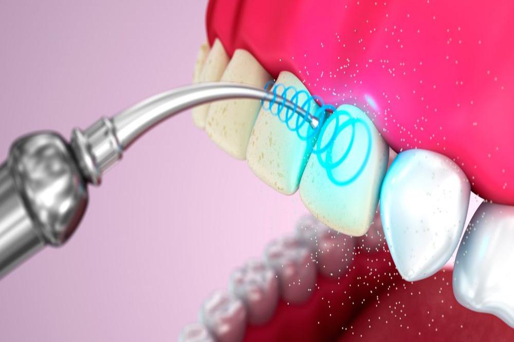 Откуда берется зубной камень — причины, удаление