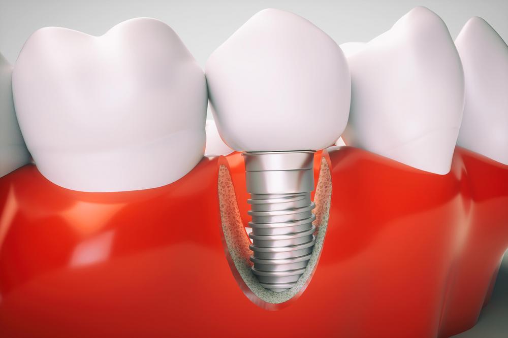 Удаление импланта зуба