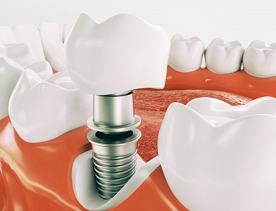 Имплантация зубов классическая